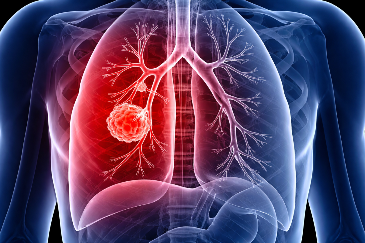 Early Signs of Cancer (High CTR Topic)